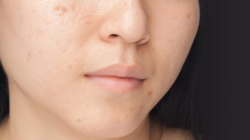 Acne scars cause loss of aesthetics, lack of confidence when communicating with people