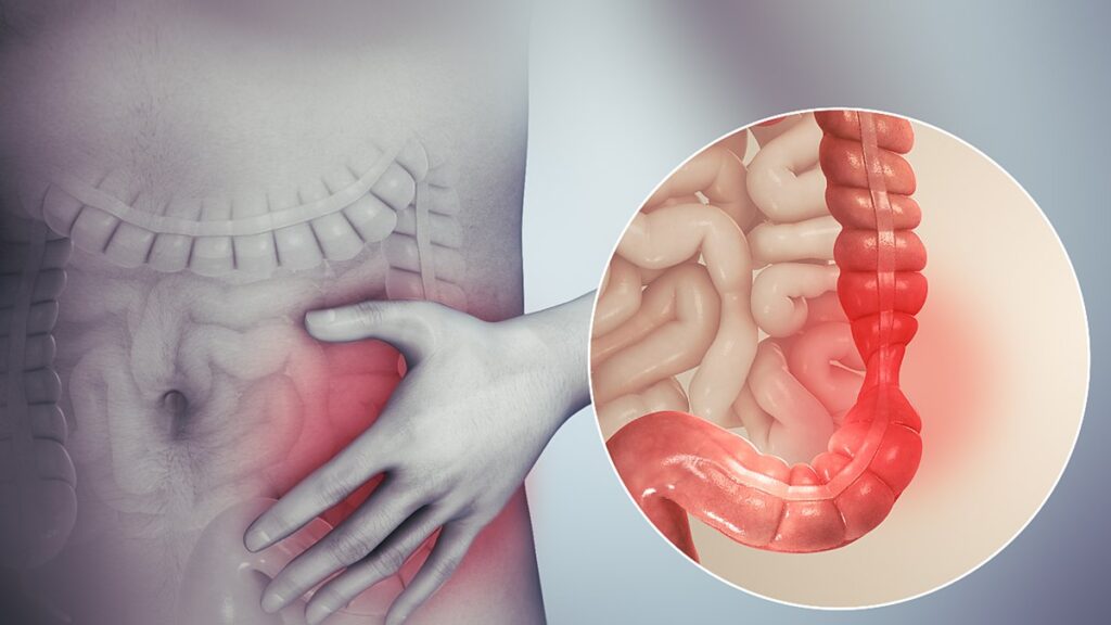 Irritable bowel syndrome is one of the leading causes of chronic diarrhea