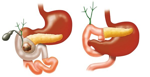 Whipple procedure: the head of the pancreas, part of the stomach and intestines is removed and then reattached