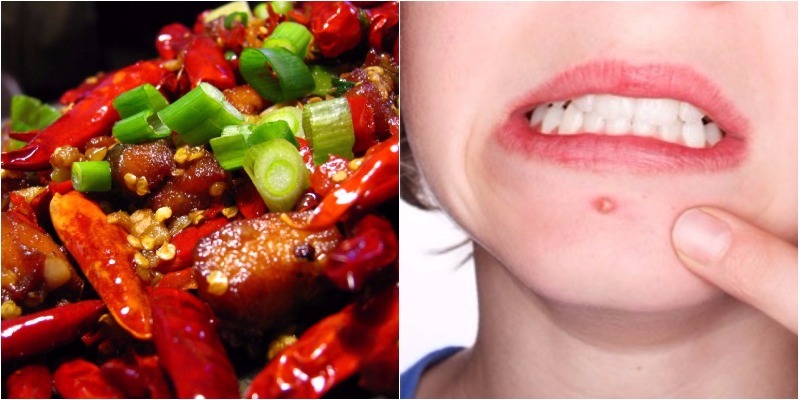 Acne and skin irritation is one of the harmful effects of eating too much spicy food, which is common in many people