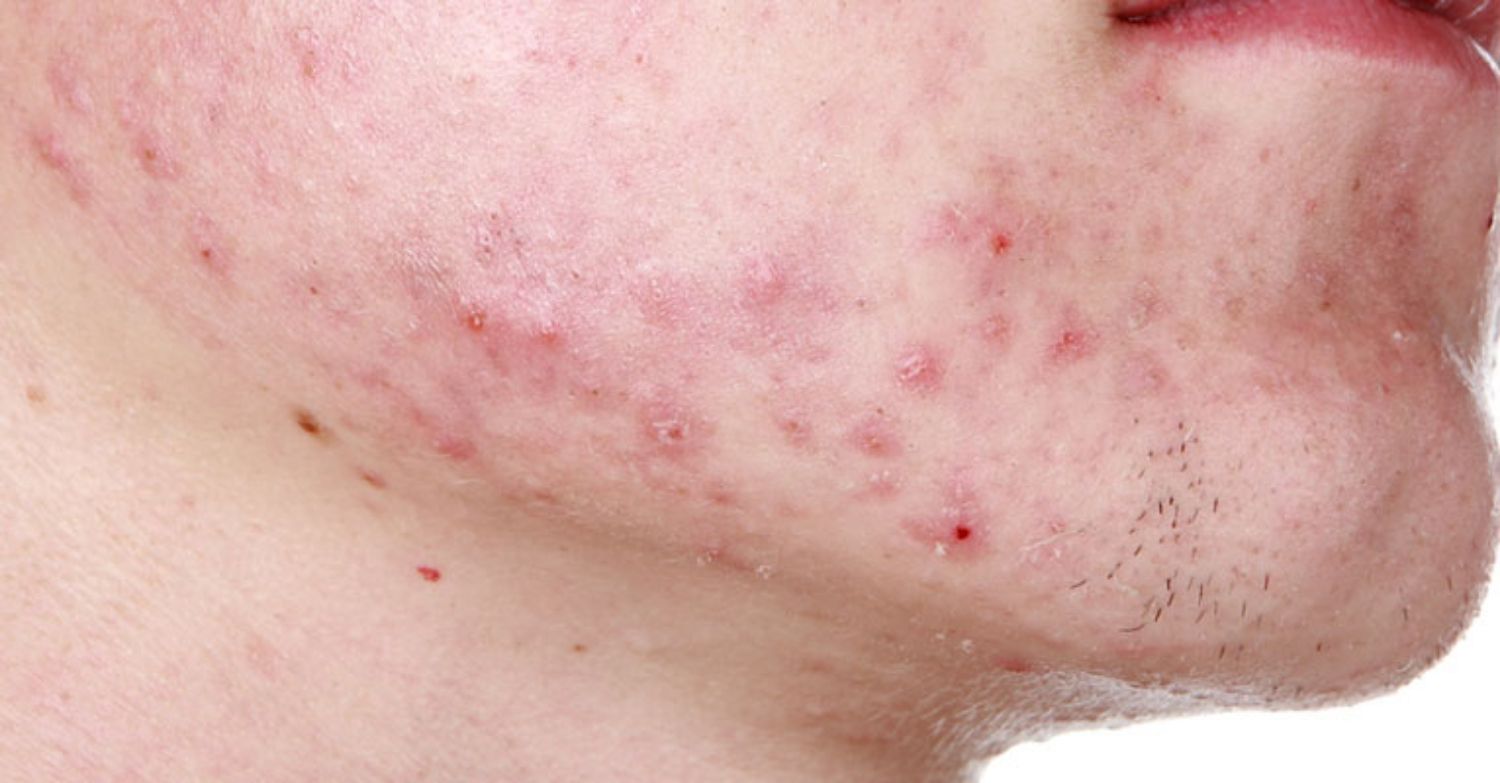 Acne on the chin causes pain and discomfort