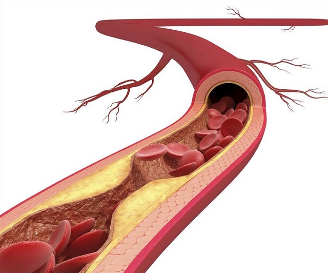 Image of arterial plaque
